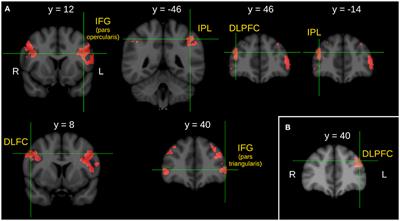 Altered Neural Activity during Irony Comprehension in Unaffected First-Degree Relatives of Schizophrenia Patients—An fMRI Study